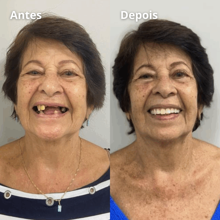 Implantes-Protese-Facetas-Lentes-Clareamento-Aparelhos-1