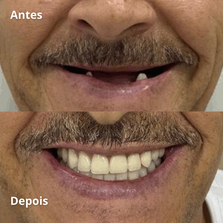 Implantes-Protese-Facetas-Lentes-Clareamento-Aparelhos-2