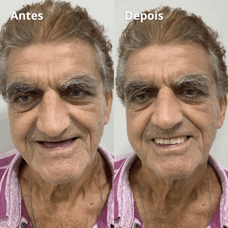 Implantes-Protese-Facetas-Lentes-Clareamento-Aparelhos-3