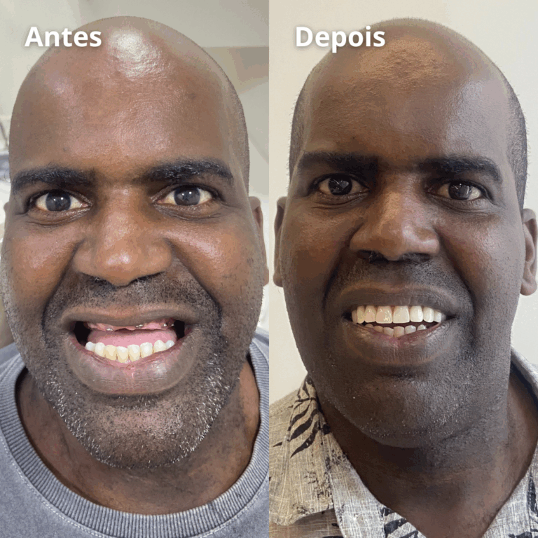 Implantes-Protese-Facetas-Lentes-Clareamento-Aparelhos-4